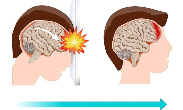 Cedera Concussion Atau Geger Otak Yang Di Alamin Seseorang