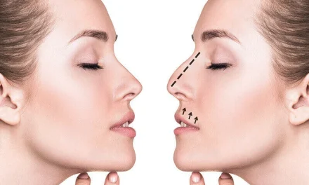 Rhinoplasty Atau Melakukan Operasi Hidung Dari Kecacatan