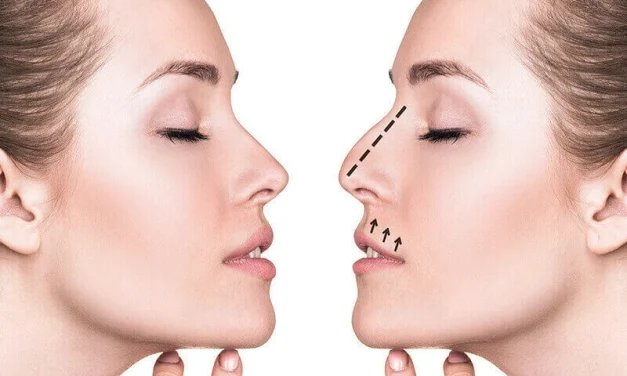 Rhinoplasty Atau Melakukan Operasi Hidung Dari Kecacatan