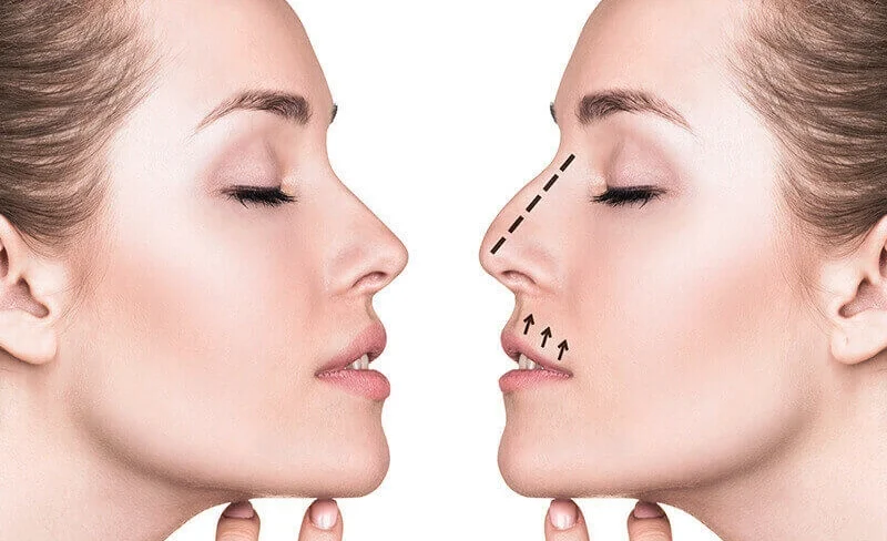 Rhinoplasty Atau Melakukan Operasi Hidung Dari Kecacatan