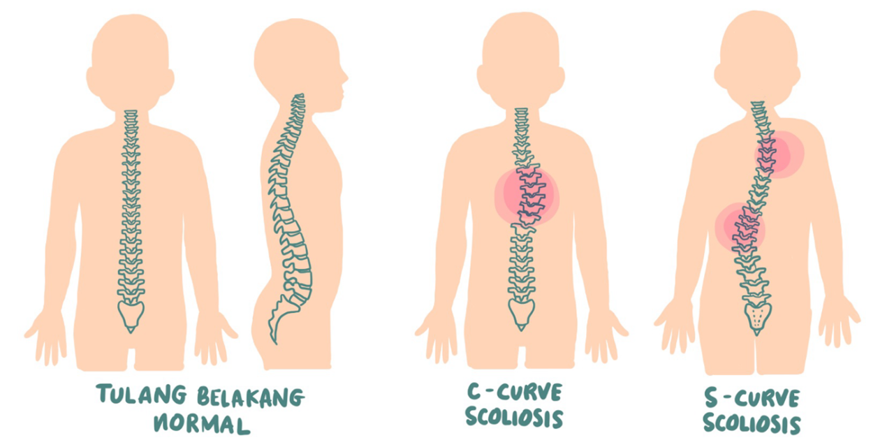 Postur Tubuh Skoliosis Yang Tidak Normal