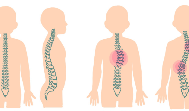 Postur Tubuh Skoliosis Yang Tidak Normal
