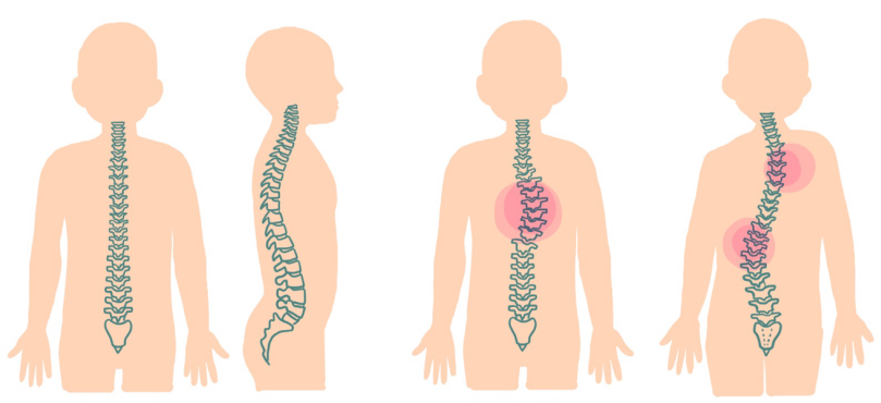 Postur Tubuh Skoliosis Yang Tidak Normal